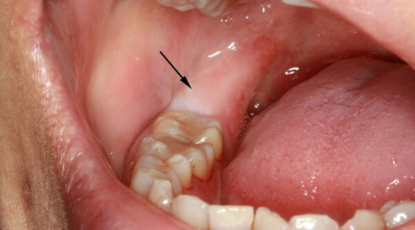 Зуб мудрости - как выглядит: описание, особенности, сроки прорезывания