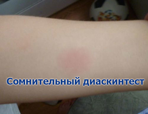 Диаскинтест результаты у детей: норма, положительный, отрицательный