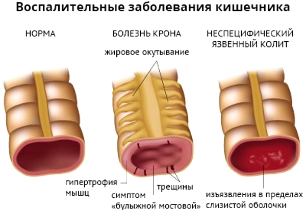 Свечи Салофальк - побочные эффекты, противопоказания и аналоги