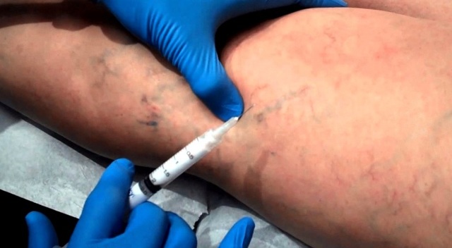 Как лечить варикоз на ногах у женщин и у мужчин и чем он опасен?