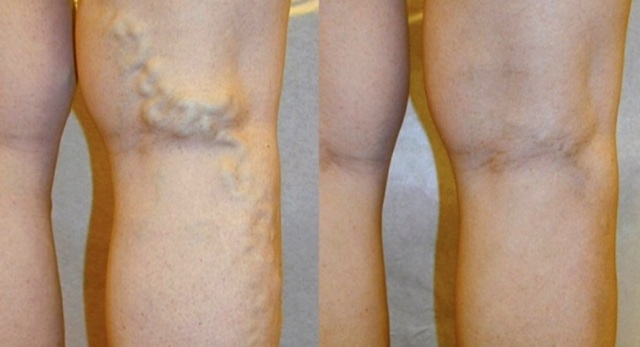 Как лечить варикоз на ногах у женщин и у мужчин и чем он опасен?