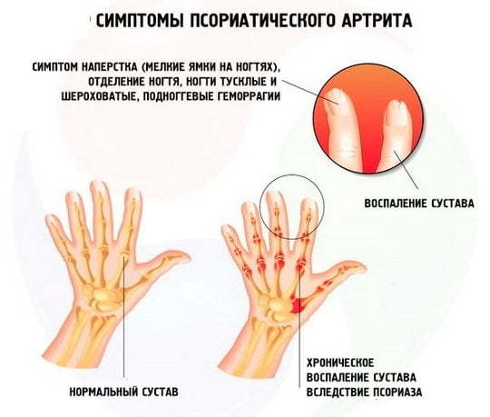 Псориатический артрит - причины, симптомы и лечение