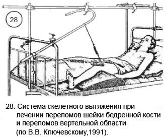 Перелом шейки бедра у пожилых людей - операция, сроки лечения