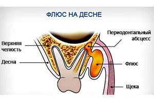 Флюс на десне: лечение, фото, причины возникновения