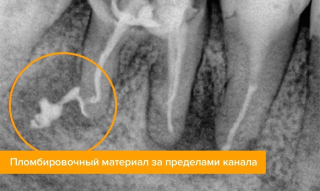 Болит зуб после удаления нерва - причины и лечение, народные средства. Как предотвратить зубную боль после удаления нерва - Автор Екатерина Данилова