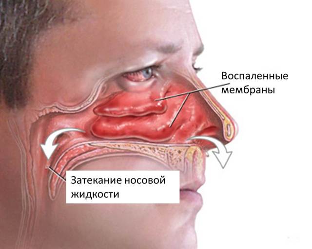 Синусит: симптомы и лечение синусита у взрослых, антибиотики — Симптомы
