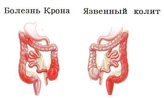 Болезнь Крона - симптомы и лечение у взрослых, причины, диагностика