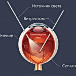 Мушки перед глазами. Причины, лечение и заболевания при которых бывают мушки в глазах.