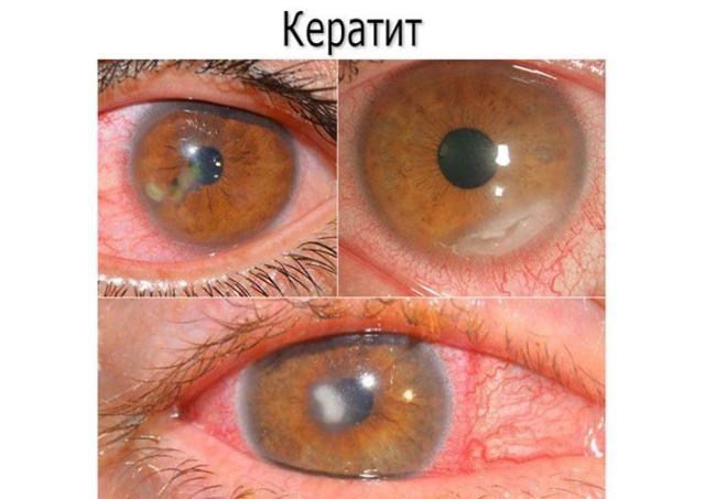 Ощущение песка в глазах, жжение и сухость: причины и лечение каплями