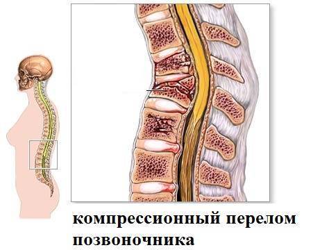 Компрессионный перелом позвоночника - лечение и реабилитация