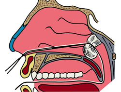 Носовое кровотечение (кровотечение из носа)