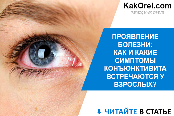 Конъюнктивит: причины, симптомы и лечение конъюнктивита