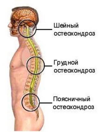 Остеохондроз поясничного отдела позвоночника: симптомы и лечение