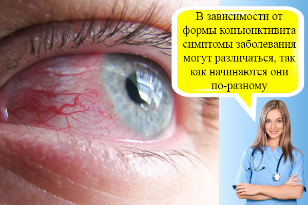 Конъюнктивит: причины, симптомы и лечение конъюнктивита