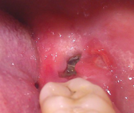 Зуб мудрости - как выглядит: описание, особенности, сроки прорезывания
