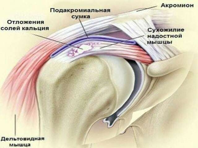 Артрит плечевого сустава (плечевой артрит) – причины, симптомы и методы лечения плечевого артрита
