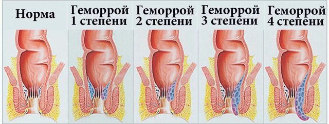 Свечи от геморроя после родов - преимущество свечей после рождения ребенка
