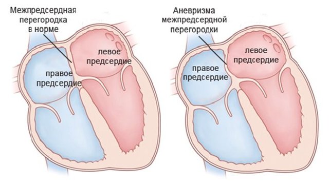 Самые опасные заболевания сердца