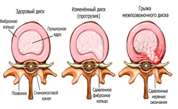 Протрузия межпозвоночного диска: симптомы и лечение