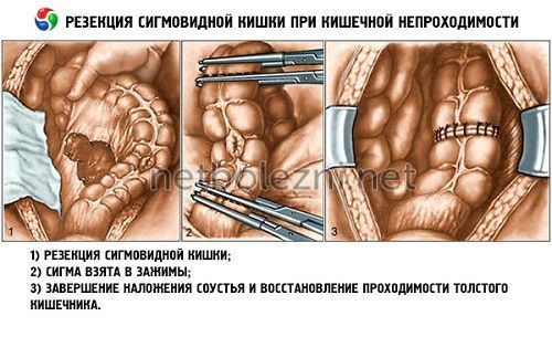 Спаечная болезнь кишечника симптомы и лечение