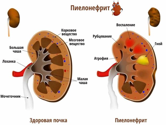 Пиелонефрит - причины, признаки, симптомы и лечение