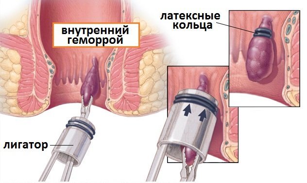 Геморрой наружный лечение и диагностика