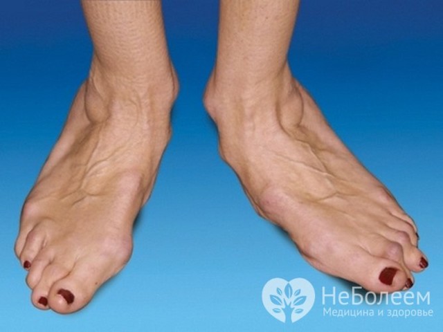 Артрит - симптомы, причины, лечение заболевания