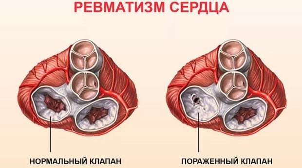 Ревматизм суставов - симптомы и лечение