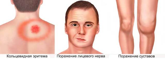 Клещевой боррелиоз - симптомы, признаки и причины болезни Лайма