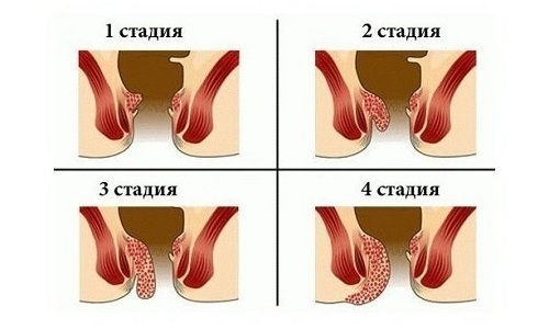 Геморрой наружный лечение и диагностика