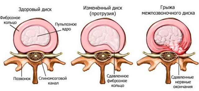 Грыжа грудного отдела позвоночника: симптомы и лечение заболевания