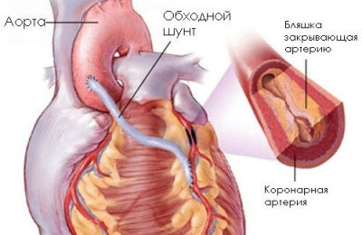 Рубцовые изменения — E-Cardio