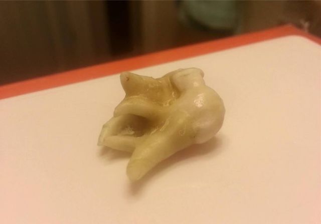 Зуб мудрости - как выглядит: описание, особенности, сроки прорезывания