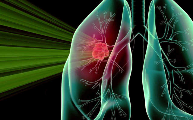 Диагностика рака легких на ранних стадиях, методы диагностики рака легких