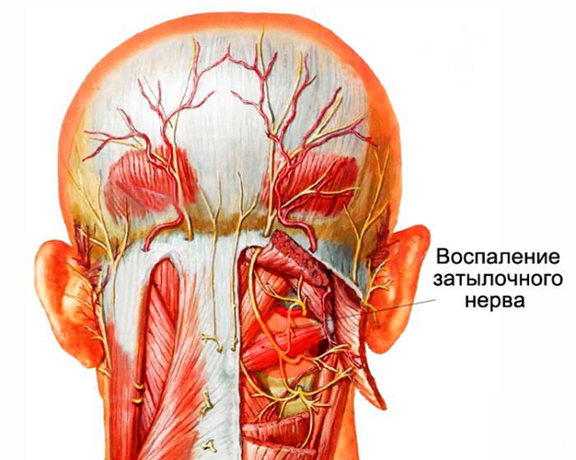 Головная боль в затылке: причины и лечение