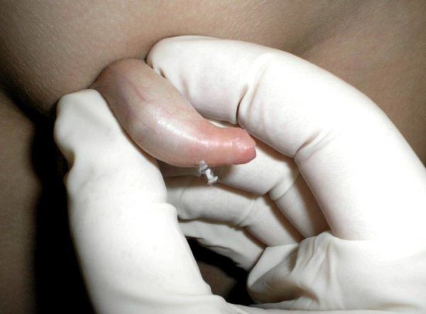 Баланопостит у ребенка: симптомы и лечение недуга