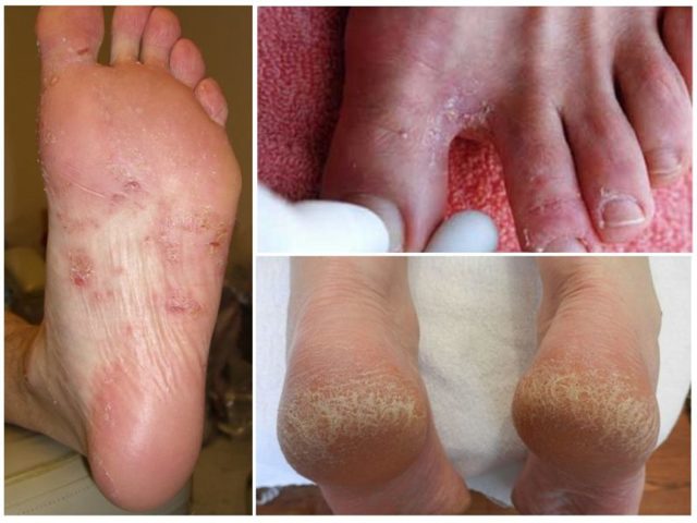 Инструкция по применению мази Пимафуцин - особенности