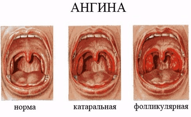 Фарингосепт - инструкция по применению таблеток при заболеваниях горла у взрослых и детей