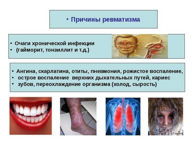 Ревматизм суставов - симптомы и лечение