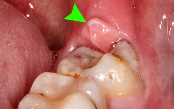 Зуб мудрости - как выглядит: описание, особенности, сроки прорезывания