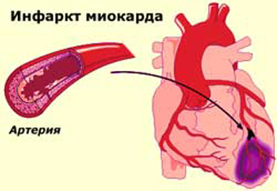 Рубцовые изменения — E-Cardio