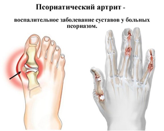 Псориатический артрит - причины, симптомы и лечение
