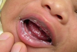 Инструкция по применению мази Пимафуцин - особенности