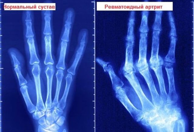 Ревматоидный артрит: диагностика и лечение