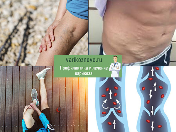 Как лечить варикоз на ногах у женщин и у мужчин и чем он опасен?