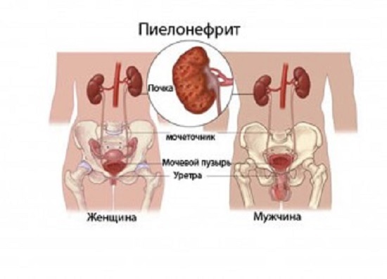Пиелонефрит - причины, признаки, симптомы и лечение