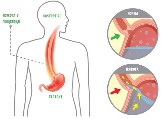 Изжога в горле: причины, симптомы, лечение