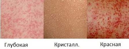 Потница у взрослых - фото, симптомы и лечение проявлений потницы