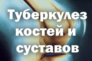 Туберкулез костей и суставов - симптомы и первые признаки