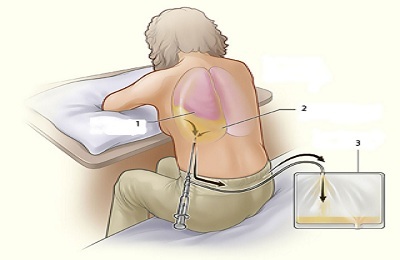 Диагностика рака легких на ранних стадиях, методы диагностики рака легких